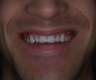 Non Prep Veneers-Hollywood Smile made...